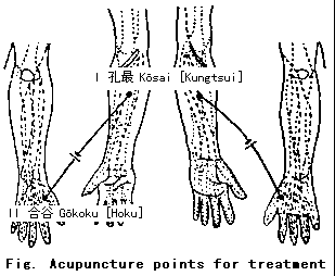 Fig. Acupunture points for treatment