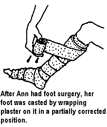 After Ann had foot surgery, her foot was casted by wrapping plaster on it in a partially corrected position.