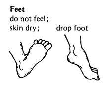 Feet do not feel., skin dry, & drop foot.