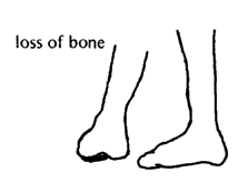 Loss of bone