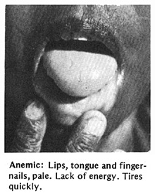 Anemic : Lips, tongue and finger-nails pale.