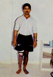 A man is wearing a Jaipur prosthesis.