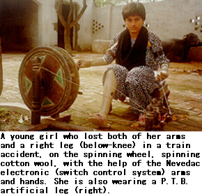 A young girl who lost both of her arms and a right leg (below-knee) in a train accident, on the spinning wheel, spinning cotton wool, with the help of the Nevedac electronic (switch control system) arms and hands. She is also wearing a P.T.B. artificial leg (right).