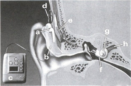 図１　人工内耳のシステム