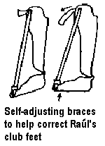 Self-adjusting braces to help correct Raúl's club feet.