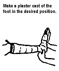 Make a plaster cast of the foot in the desired position.