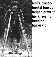 Noes's plastic-bucket braces helped prevent his knees from bending backward.