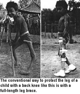 The conventional way to protect the leg of a child with a back knee like this is with a full-length leg brace.