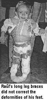 Raul's long leg braces did not correct the deformities of his feet.