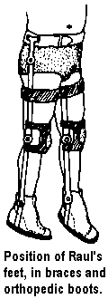 Position of Raul's feet, in braces and orthopedic boots.
