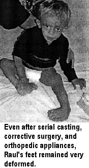 Even after serial casting, corrective surgery, and orthopedic appliances, Raul's feet remained very deformed.