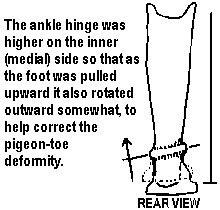 The ankle hinge was higher on the inner (medial) side so that as the foot was pulled upward it also rotated outward somewhat, to help correct the pigeon-toe deformity.