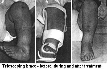 Telescoping brace - before, during and after treatment.