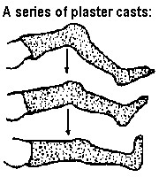 A series of plaster casts: various angles at knee.