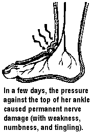 In a few days, the pressure against the top of her ankle caused permanent nerve damage (with weakness, numbness, and tingling).