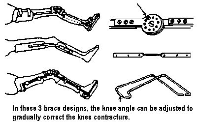 In these 3 brace designs, the knee angle can be adjusted to gradually correct the knee contracture.