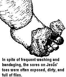 In spite of frequent washing and bandaging, the sores on Jesus' toes were often exposed, dirty, and full of flies.