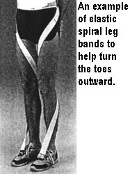 An example of elastic spiral leg bands to help turn the toes outward.