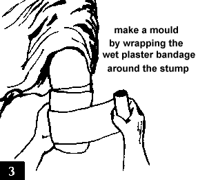 Figure 3. Making a mould by wrapping the wet plaster bandage around the stump.