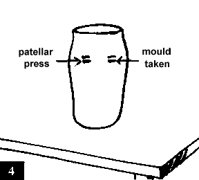 Figure 4. When you take the mould, watch out the patellar press.