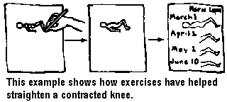 This example shows how exercises have helped straighten a contracted knee.