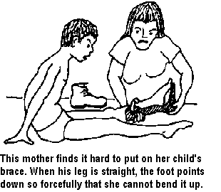 This mother finds it hard to put on her child's brace. When his leg is straight, the foot points down so forcefully that she cannot bend it up.