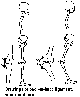 Drawings of back-of-knee ligament, whole and torn.