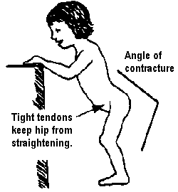 Tight tendons keep hip from straightening.