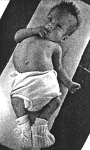 A baby with spina bifida