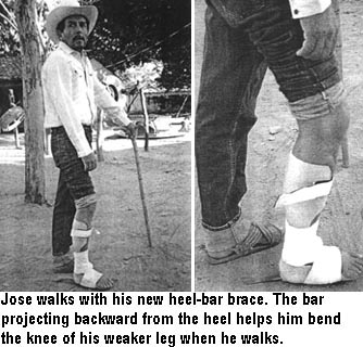 Josés walks with his new heel-bar brace. The bar projecting backward from the heel helps him bend the knee of his weaker leg when he walks.