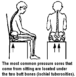 The most common pressure sores that come from sitting are located under the two butt bones (ischial tuberosities).