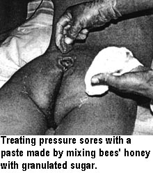 Treating pressure sores with a paste made by mixing bees' honey with granulated sugar. 