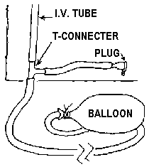A small plastic T-connecter with a plug were inserted in each tube a few cm from the balloons.
