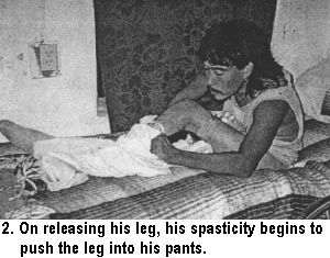 2. On releasing his leg, his spasticity begins to push the leg into his pants.