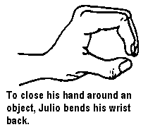 To close his hand around an object, Julio bends his wrist back.