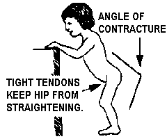 Tight tendons keep hip from straightening.
