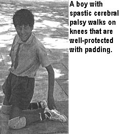 A boy with spastic cerebral palsy walks on knees that are well-protected with padding.