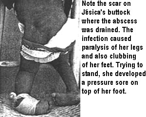 Note the scar on Jesica's buttock where the abscess was drained. The infection caused paralysis of her legs and also clubbing of her feet. Trying to stand, she developed a pressure sore on top of her foot.