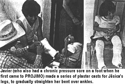 Javier (who also had a chronic pressure sore on a foot when he first came to PROJIMO) made a series of plaster casts for Jésica's legs, to gradually straighten her bent over ankles.