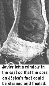 Javier left a window in the cast so that the sore on Jésica's foot could be cleaned and treated.
