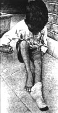 A photograph of a child with a plaster cast on his leg.