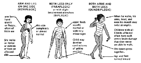 ARM AND LEG ON ONE SIDE (HEMIPLEGIC), BOTH LEGS ONLY (PARAPLEGIC) or with slight involvement elsewhere (DIPLEGIC), BOTH ARMS AND BOTH LEGS (QUADRIPLEGIC)