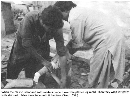 When the plastic is hot and soft, workers drape it over the plaster leg mold.