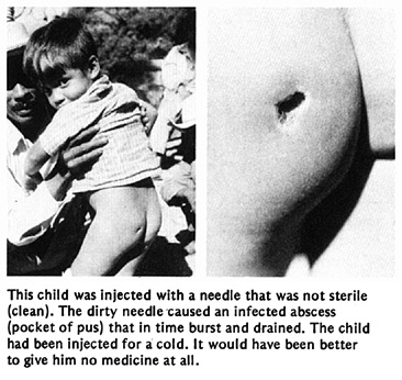 This child was injected with a needle that was not sterile (clean). The dirty needle caused an infected abscess (pocket of pus) that in time burst and drained. The child had been injected for a cold. It would have been better to give him no medicine at all.