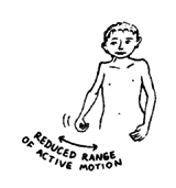 Reduced range of active motion.