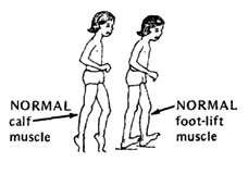 Normal calf muscle & foot-lift muscle.