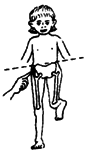 normal - The child stands straight. The hip tilts up on the lifted leg