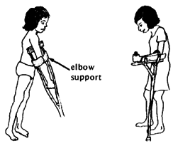 She may be able to use a crutch with an elbow support.