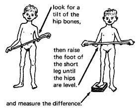 look for a tilt of the hip bones, then raise the foot of the short leg until the hips are level and measure the difference.
