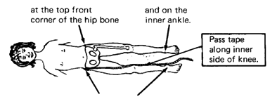 at the top front corner of the hip bone and on the inner ankle.